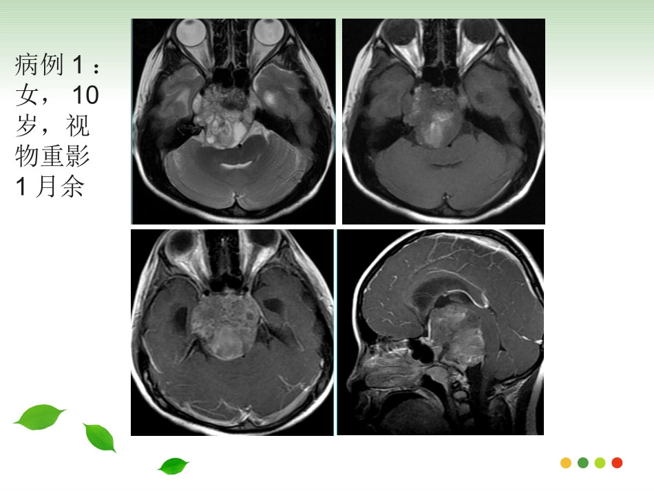 斜坡脊索瘤的影像诊疗_第1页
