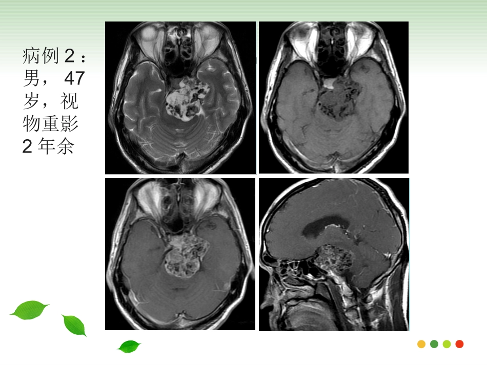 斜坡脊索瘤的影像诊疗_第2页
