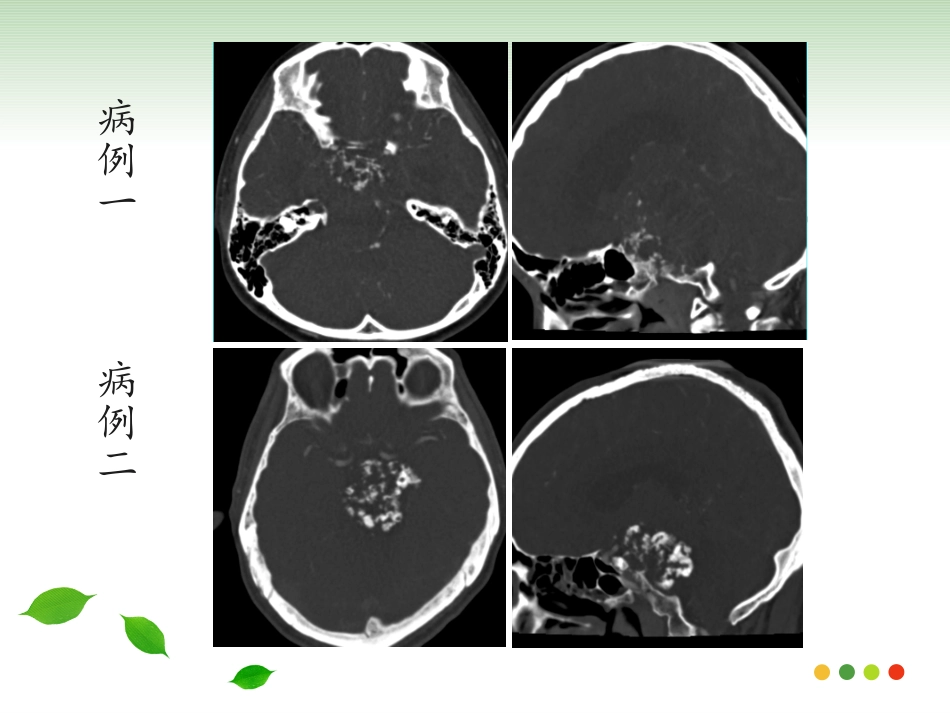 斜坡脊索瘤的影像诊疗_第3页