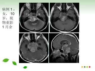 斜坡脊索瘤的影像诊疗