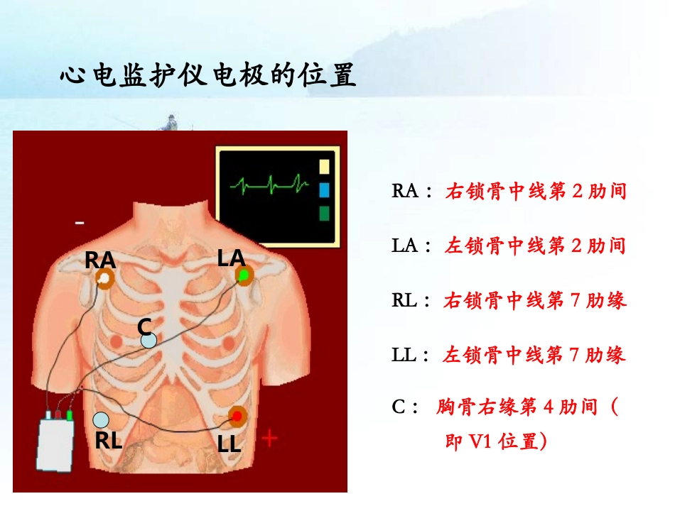 心电图心律失常的识别_第2页