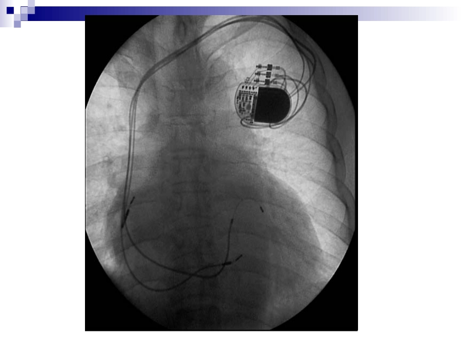 心脏起搏器图文_第3页