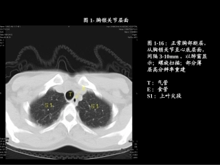 胸部ct解剖及典型病例CT征象