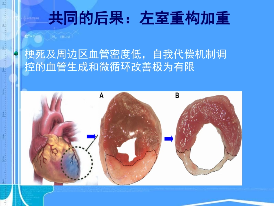 血管新生治疗急性心肌梗死_第3页