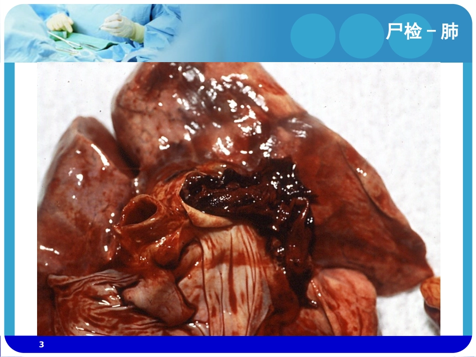 血栓形成过程和类型_第3页