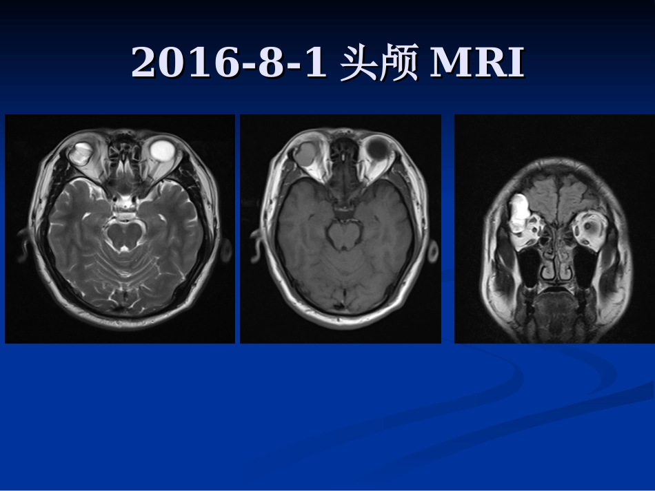 眼眶表皮样囊肿_第2页