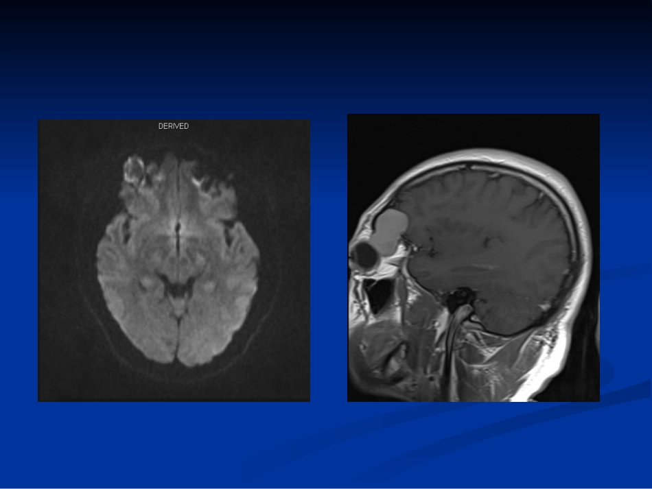 眼眶表皮样囊肿_第3页