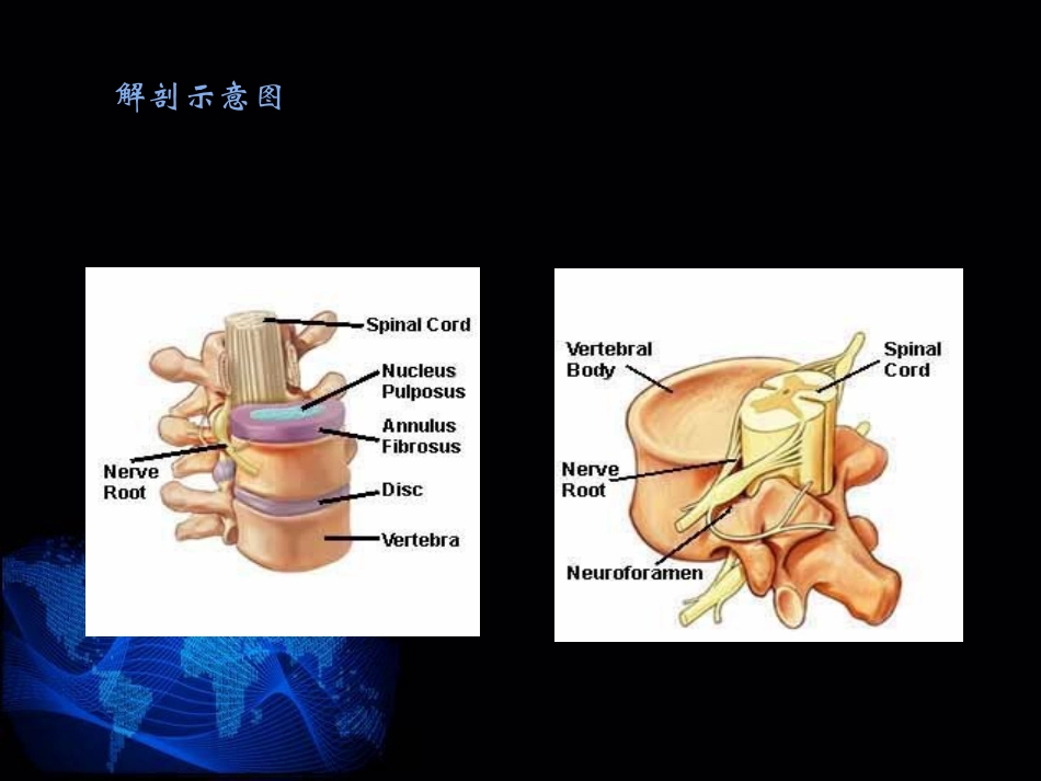 腰椎间盘突出症康复治疗_第3页