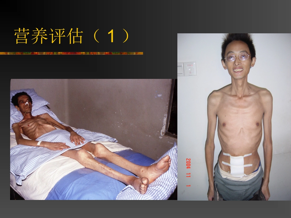 医学课件外科学总论外科营养_第2页