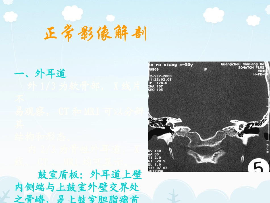 医学影像耳的CT影像解剖及常见疾病诊疗_第3页