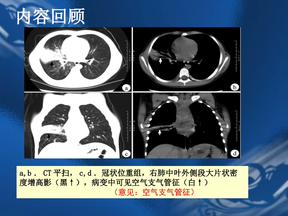 医学影像诊疗学呼吸系统_第2页