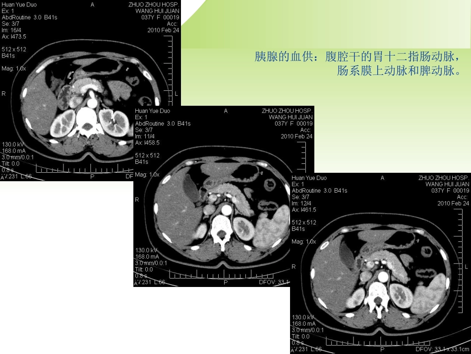 胰腺癌的影像诊疗课件_第3页