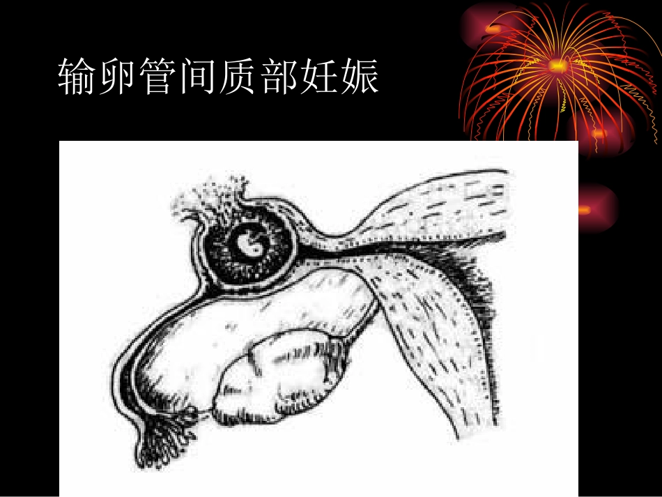 异位妊娠的诊疗和_第3页