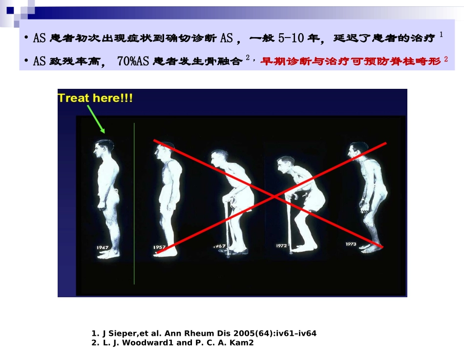 由临床病例看强直性脊柱炎临床诊治_第2页