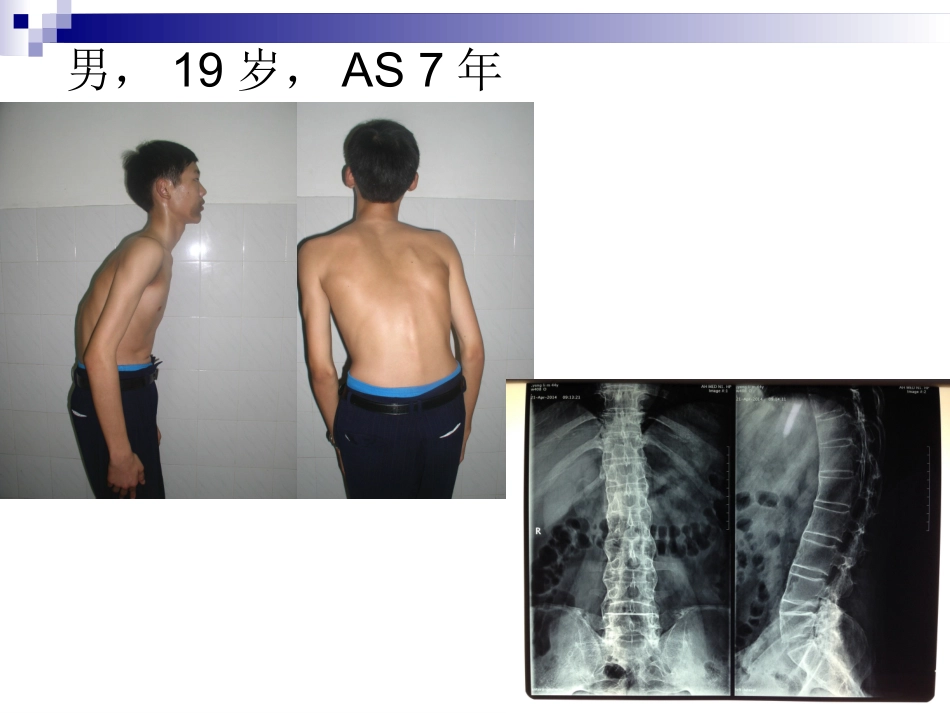 由临床病例看强直性脊柱炎临床诊治_第3页
