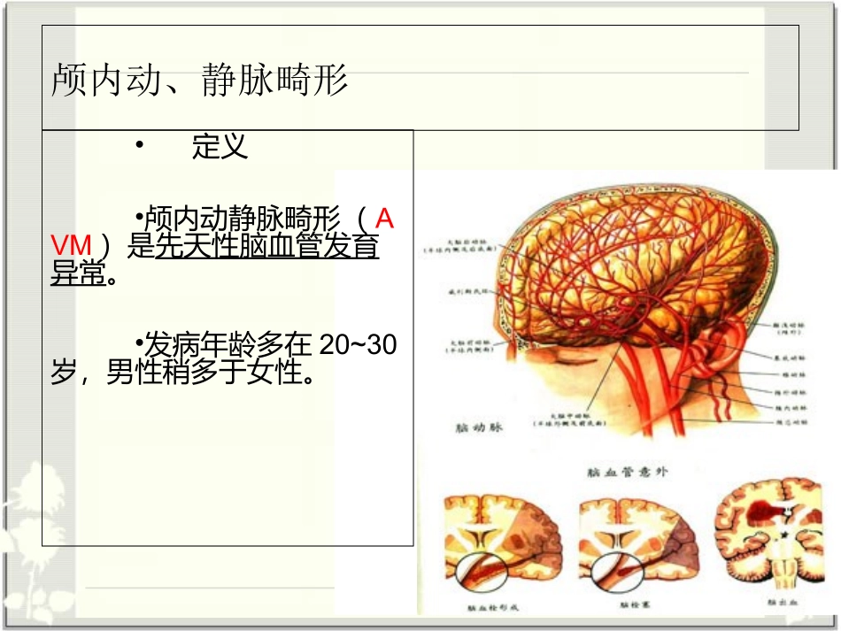 AVM颅内动静脉畸形的护理查房医学知识讲解讲义_第3页