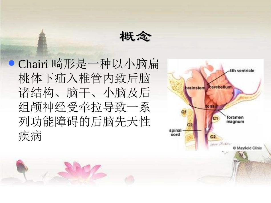 Chiari畸形_第2页