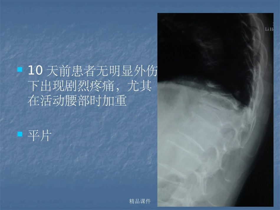 kummell病_第3页