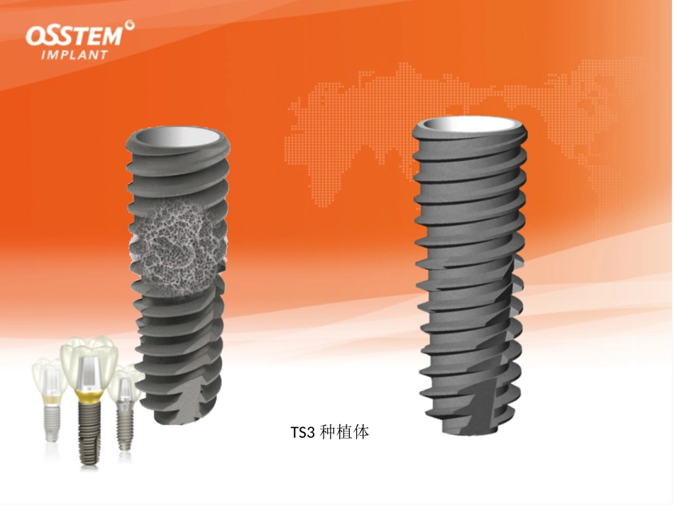 奥齿泰修复取模_第2页