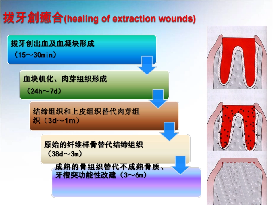 拔牙并发症及拔牙创愈合_第3页