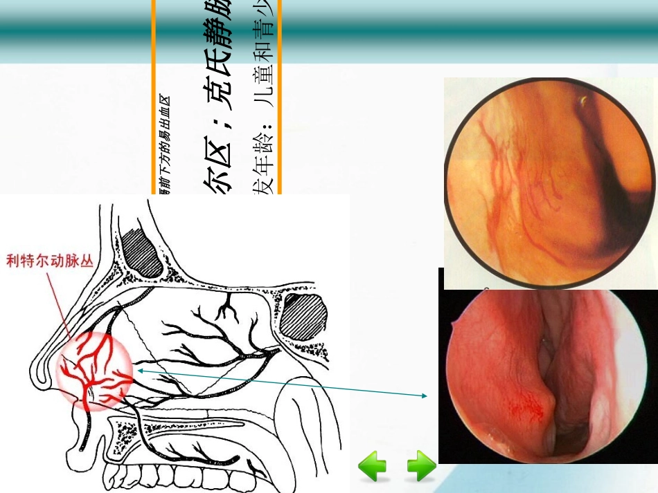 鼻出血尹兴红_第3页