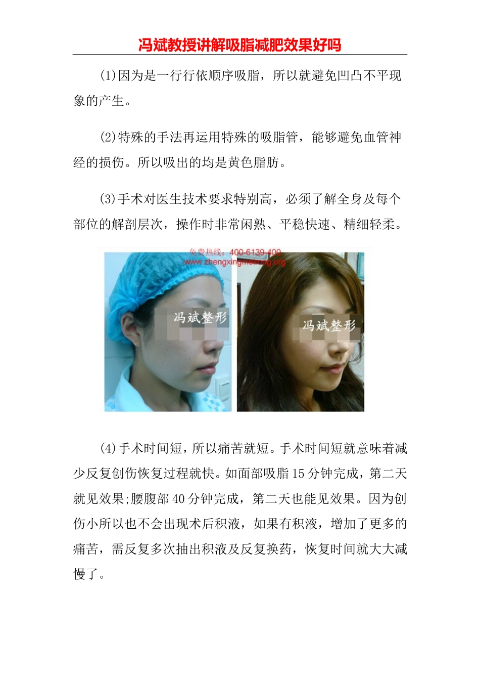 吸脂减肥效果好吗_第2页