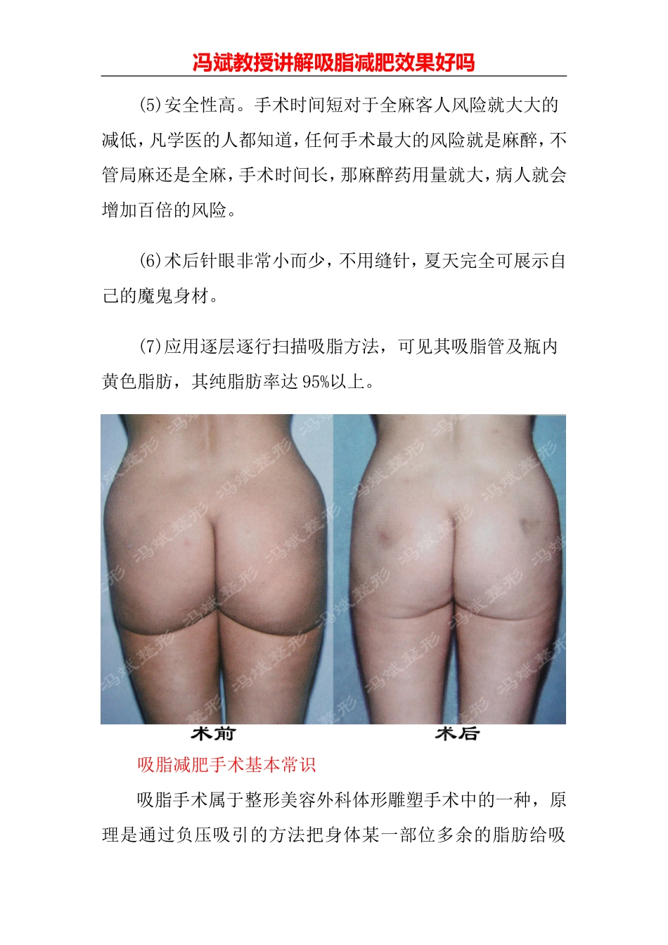 吸脂减肥效果好吗_第3页