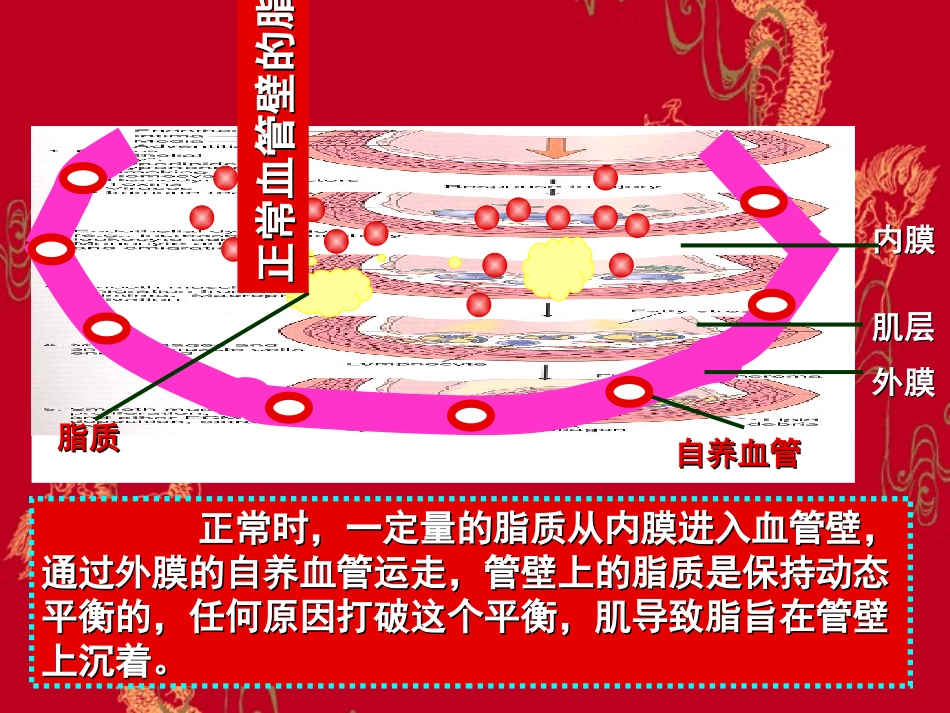 病理学动脉粥样硬化_第3页