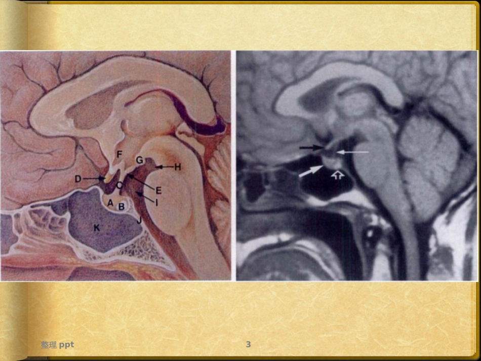 垂体病变Rathke囊肿_第3页