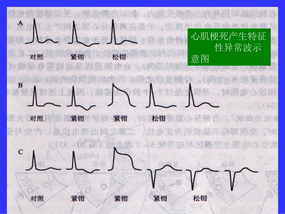 第四节心肌梗死与心肌缺血_第2页