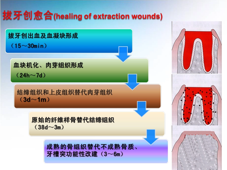 第五节胡开进汪涌拔牙并发症及拔牙创愈合资料_第3页