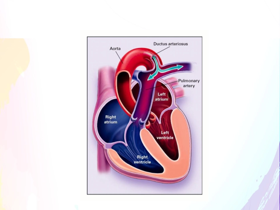动脉导管未闭_第3页