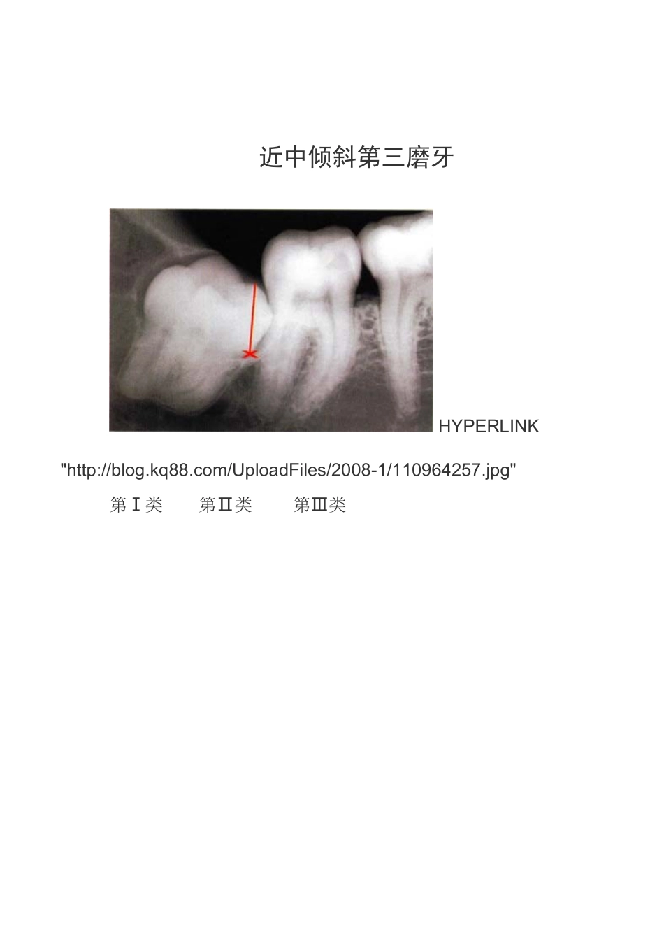 各种阻生牙的处理方法_第2页