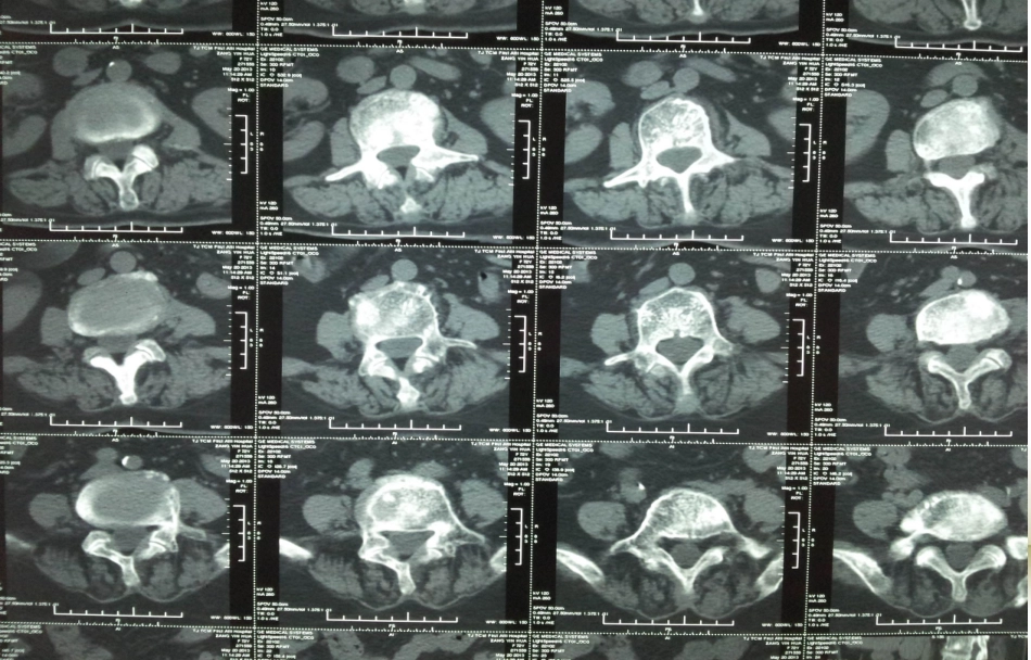 多发性肿瘤骨转移诊断与治疗_第3页