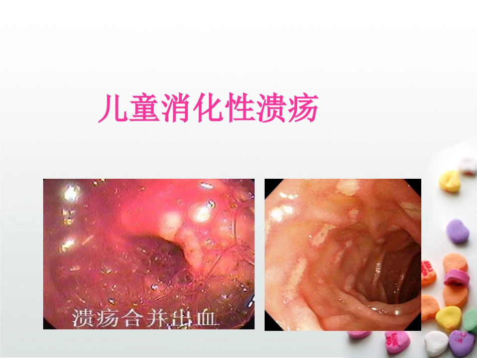 儿童消化性溃疡_第1页