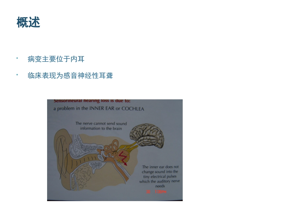 耳鼻喉内耳疾病_第2页