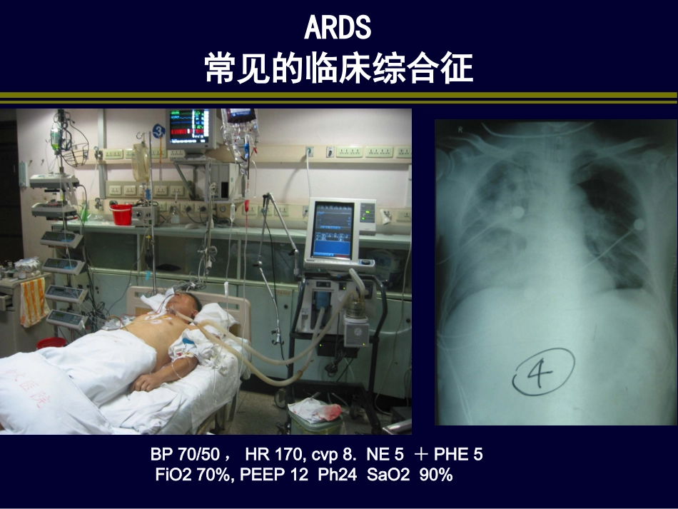 肺保护性通气_第2页