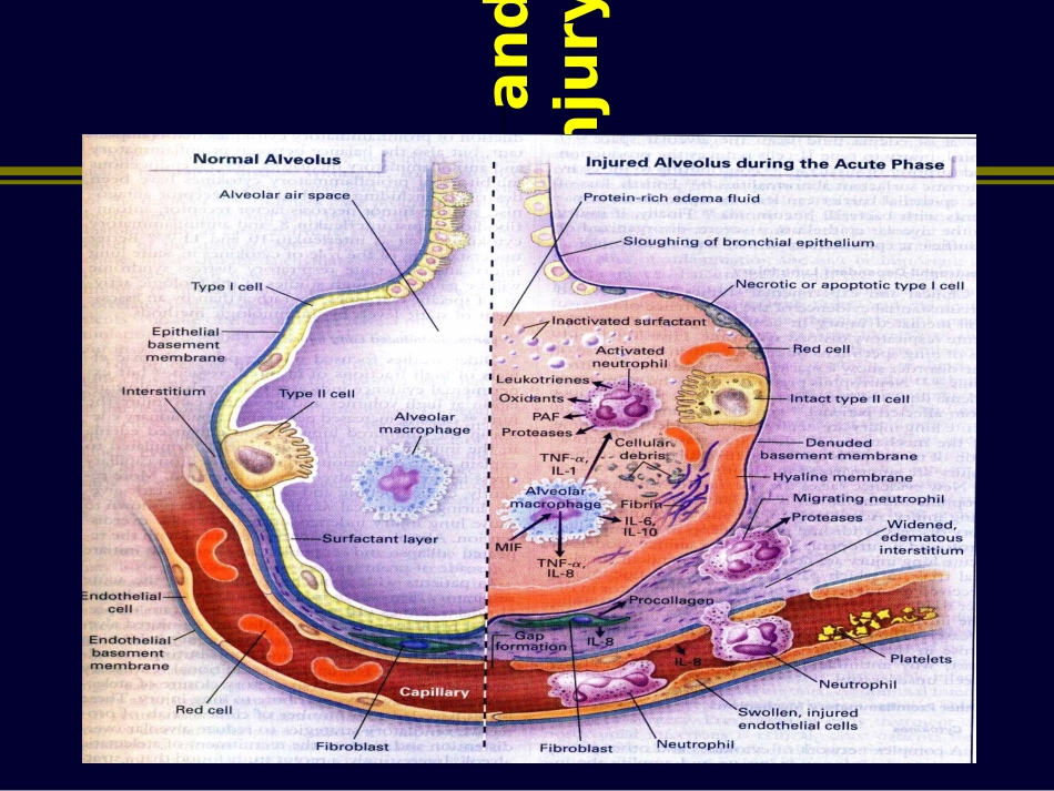肺保护性通气_第3页