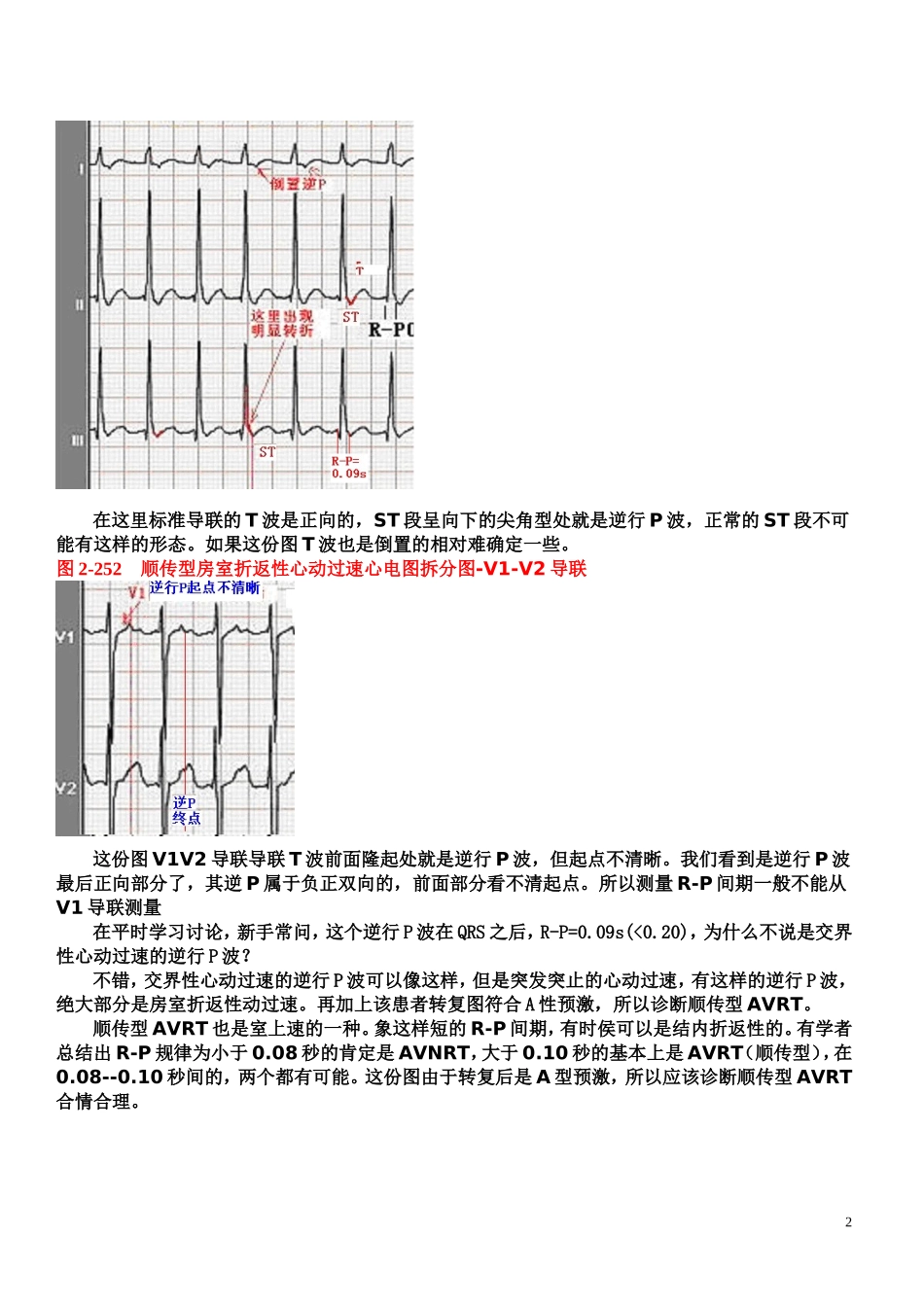 另类心电图讲义-8---折返性心律失常_第2页