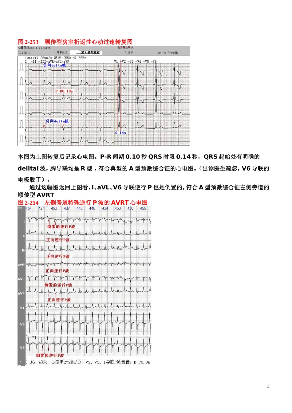 另类心电图讲义-8---折返性心律失常_第3页