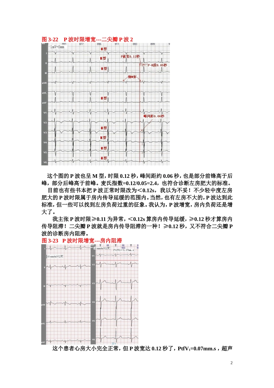 另类心电图学讲义4--P波时限与电压_第2页