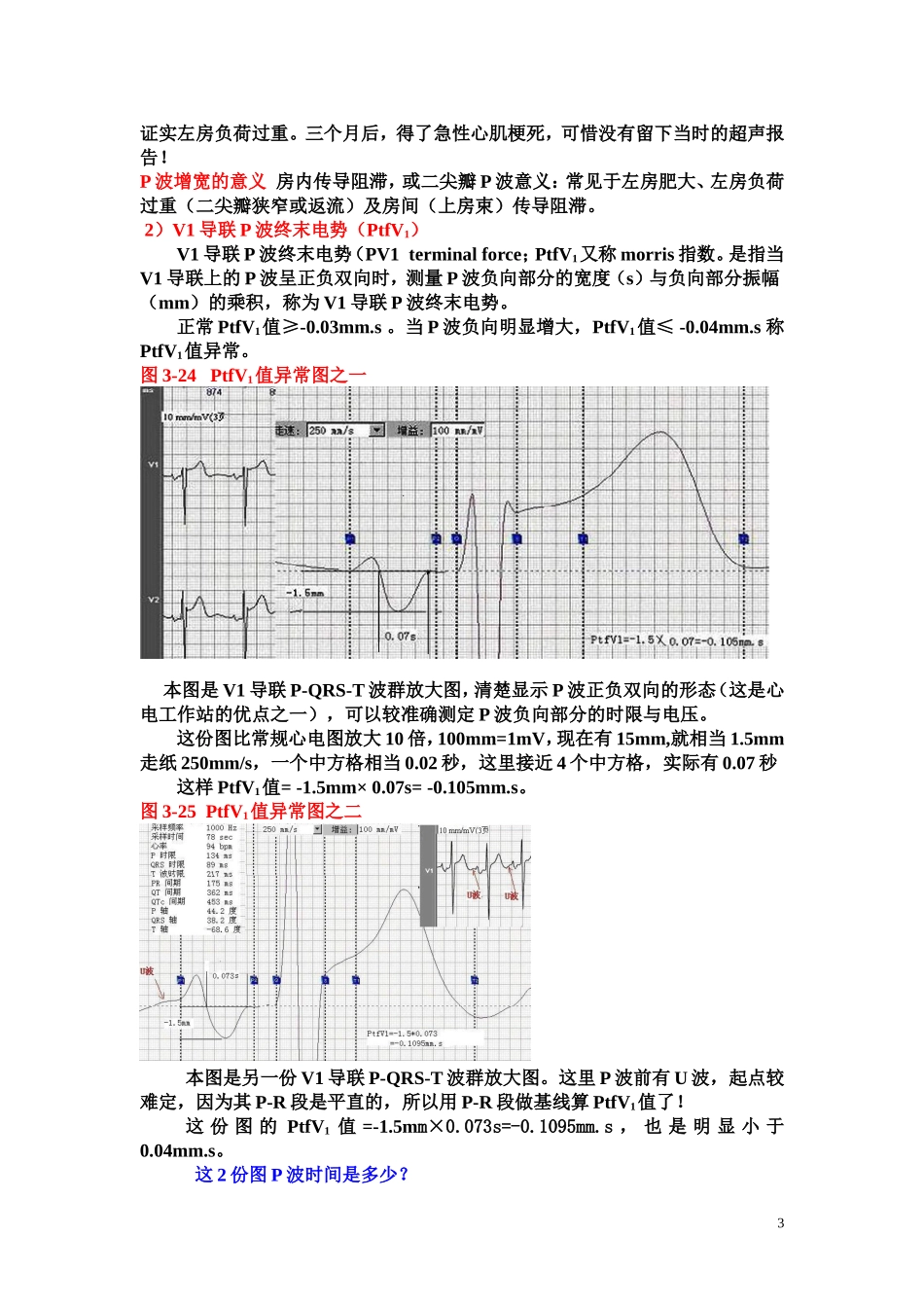 另类心电图学讲义4--P波时限与电压_第3页