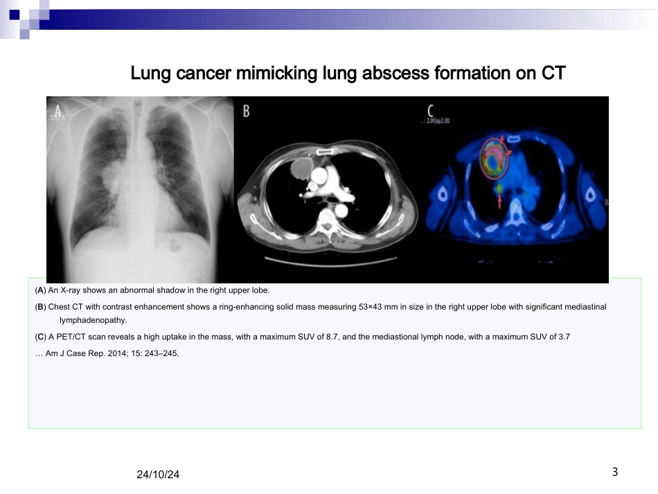 肺脓肿影像诊断_第3页