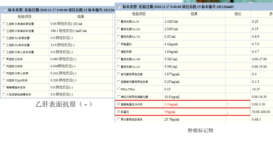 肝脏上皮样血管内皮瘤影像学表现_第3页