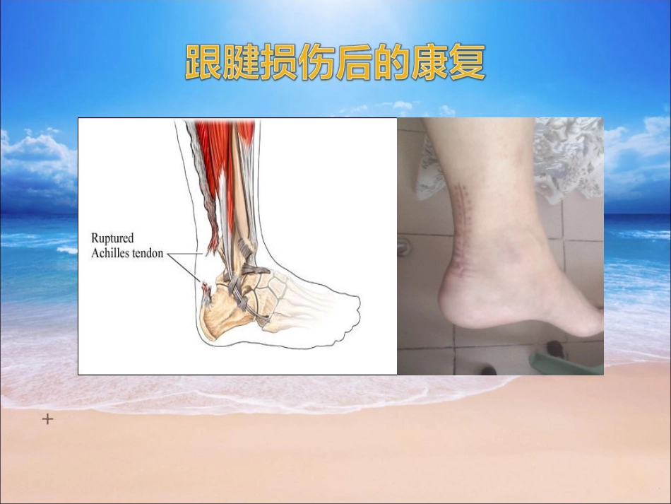 跟腱断裂的康复_第1页