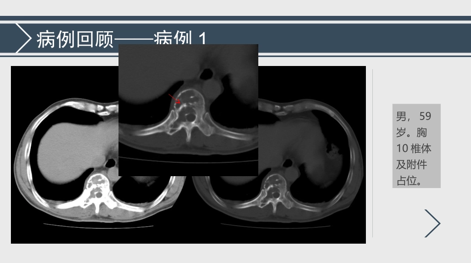 孤立性浆细胞瘤诊断与鉴别诊断_第2页