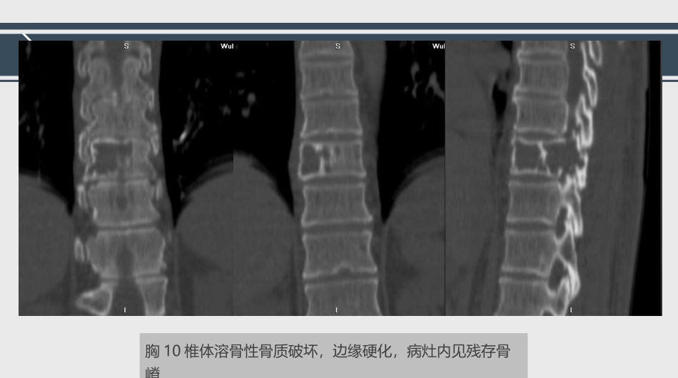 孤立性浆细胞瘤诊断与鉴别诊断_第3页