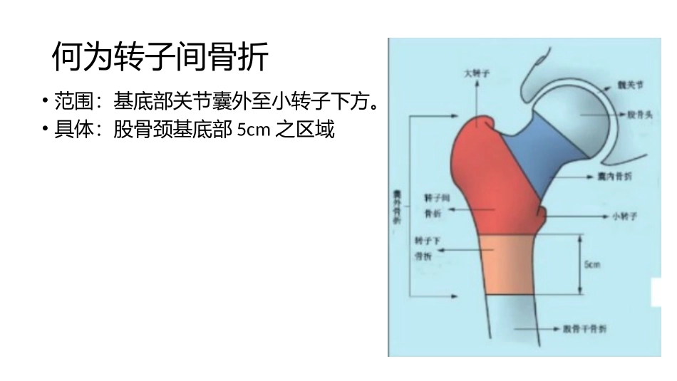 股骨粗隆间分型_第2页