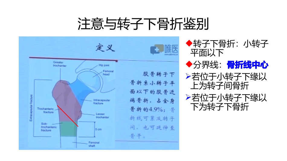 股骨粗隆间分型_第3页