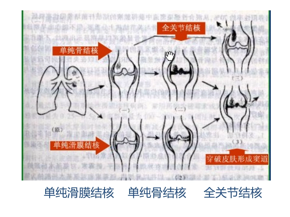骨与关节结核病人的护理_第3页